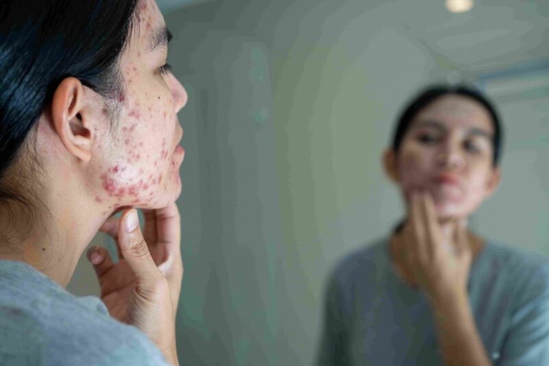 Woman examining acne on her jawline in a mirror, showing clustered breakouts on the lower face