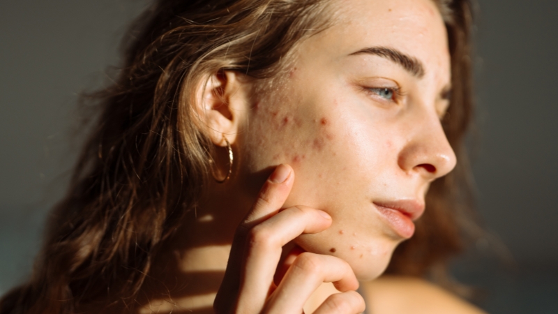 Side view of a woman touching acne spots and dark marks on her cheek