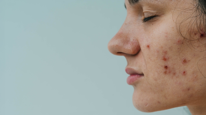 Side view of a face with visible acne spots and dark marks on the cheek