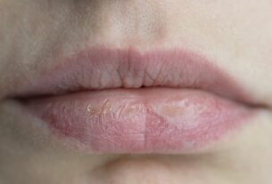 Close-up of dry, cracked lips showing signs of dehydration or nighttime dry mouth
