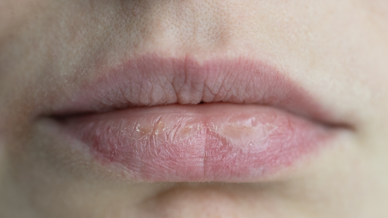 Close-up of dry, cracked lips showing signs of dehydration or nighttime dry mouth
