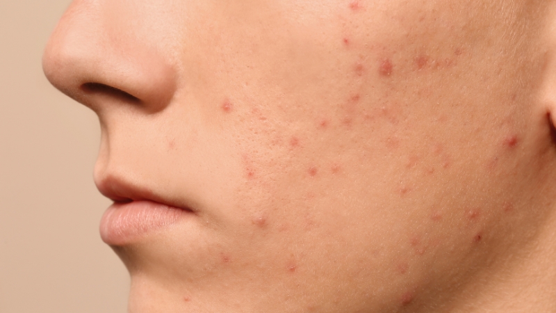 Close-up of small red acne bumps scattered across the cheek and jawline