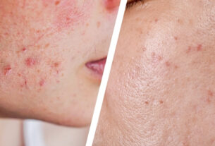 Fungal acne vs acne comparison showing different types of bumps and skin patterns