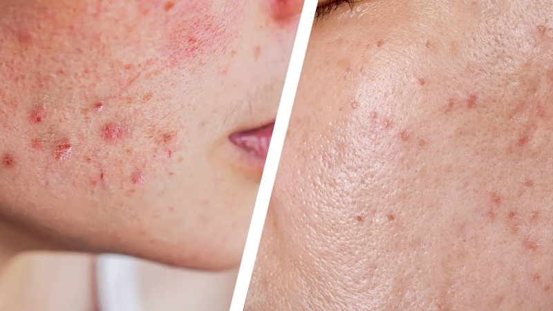 Fungal acne vs acne comparison showing different types of bumps and skin patterns