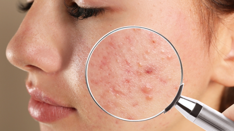 Close-up of facial acne examined with a magnifying glass showing inflamed bumps