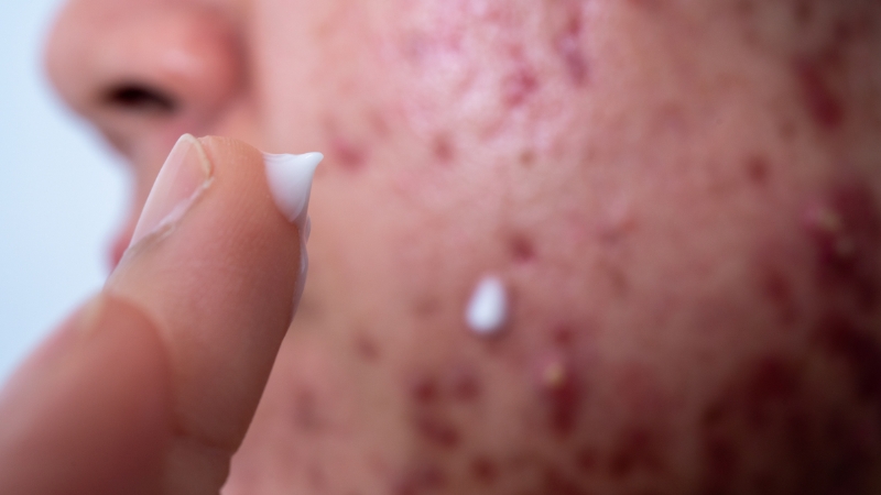 Close-up of acne-prone skin with cream being applied to inflamed red bumps