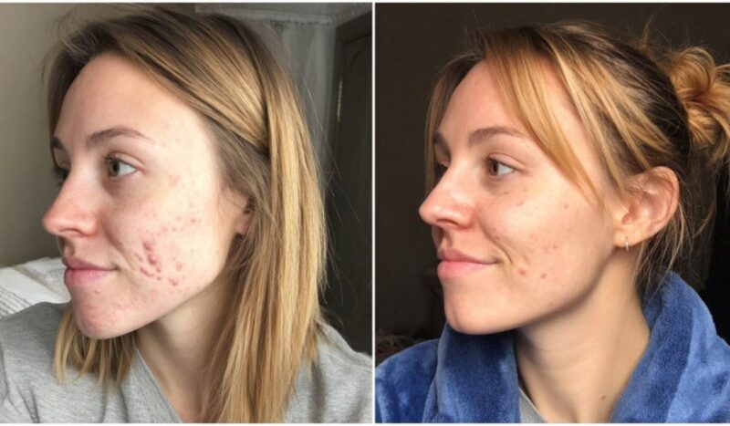 Side-by-side comparison of a woman’s face with acne before treatment and clearer skin after treatment