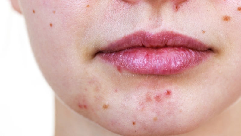 Close-up of the lower face with acne spots and dark marks around the chin and mouth