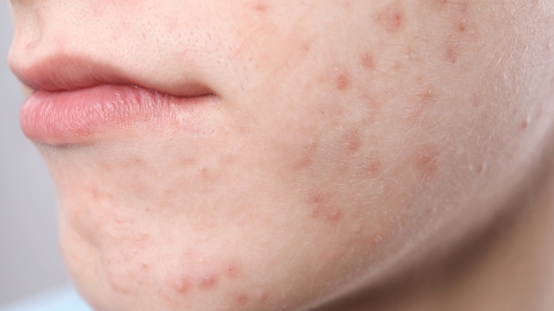 Close-up of small uniform red bumps on the cheek and jaw area