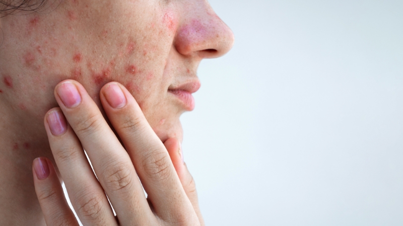 Close-up of red inflamed acne bumps on the cheek being touched by a hand